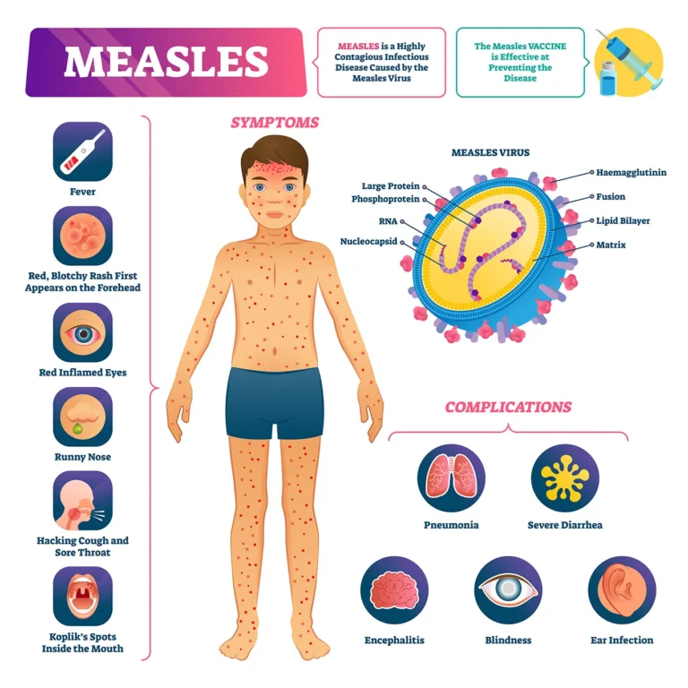 Measles Cases Surge Across Texas, While DeWitt County Remains in the Clear